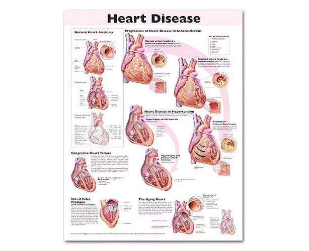 Heart Disease Anatomical Chart, 2nd Edition